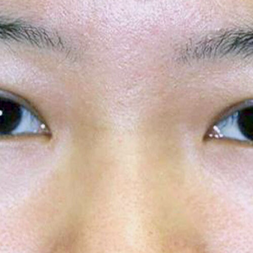 Asian Double Eyelid Surgery Gallery